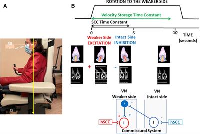 Vestibular rehabilitation improves spontaneous nystagmus normalization in patients with acute unilateral vestibulopathy